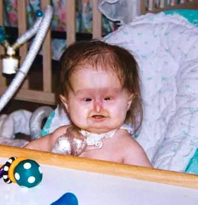 Baby Born With Unusual Syndrome – 22 Years Later She Looks Amazing