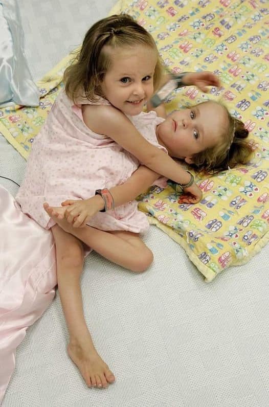 These Siamese Twins were Separated when They were 4 Years old: How are They Doing Now?