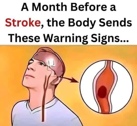 A Month Before a Stroke…