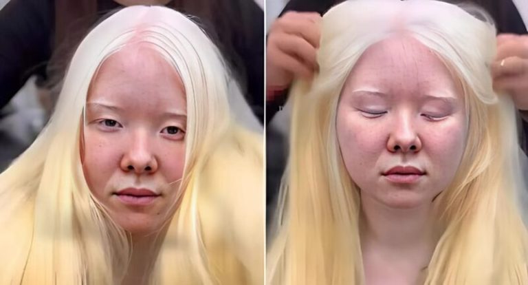 This Albino Girl Revealed Her New Brunette Look