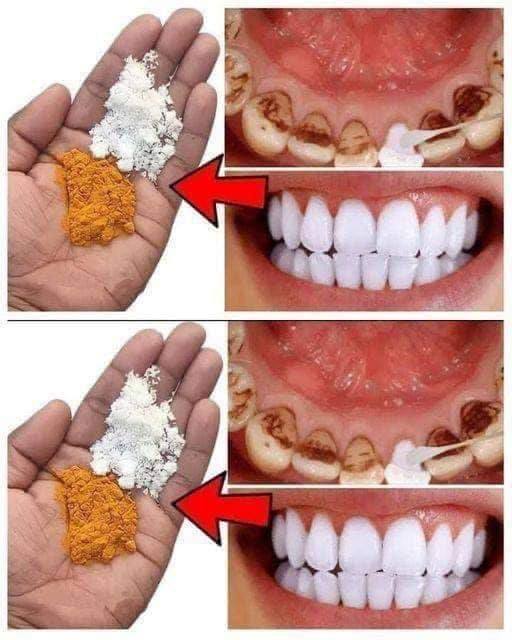 Say Goodbye to Yellowing Teeth